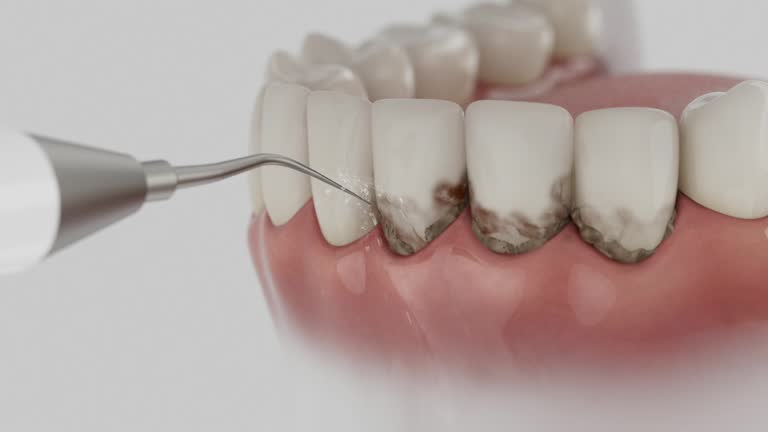 Trusted Wisdom Tooth Removal service in New Stanton, PA - Dentist Open Now